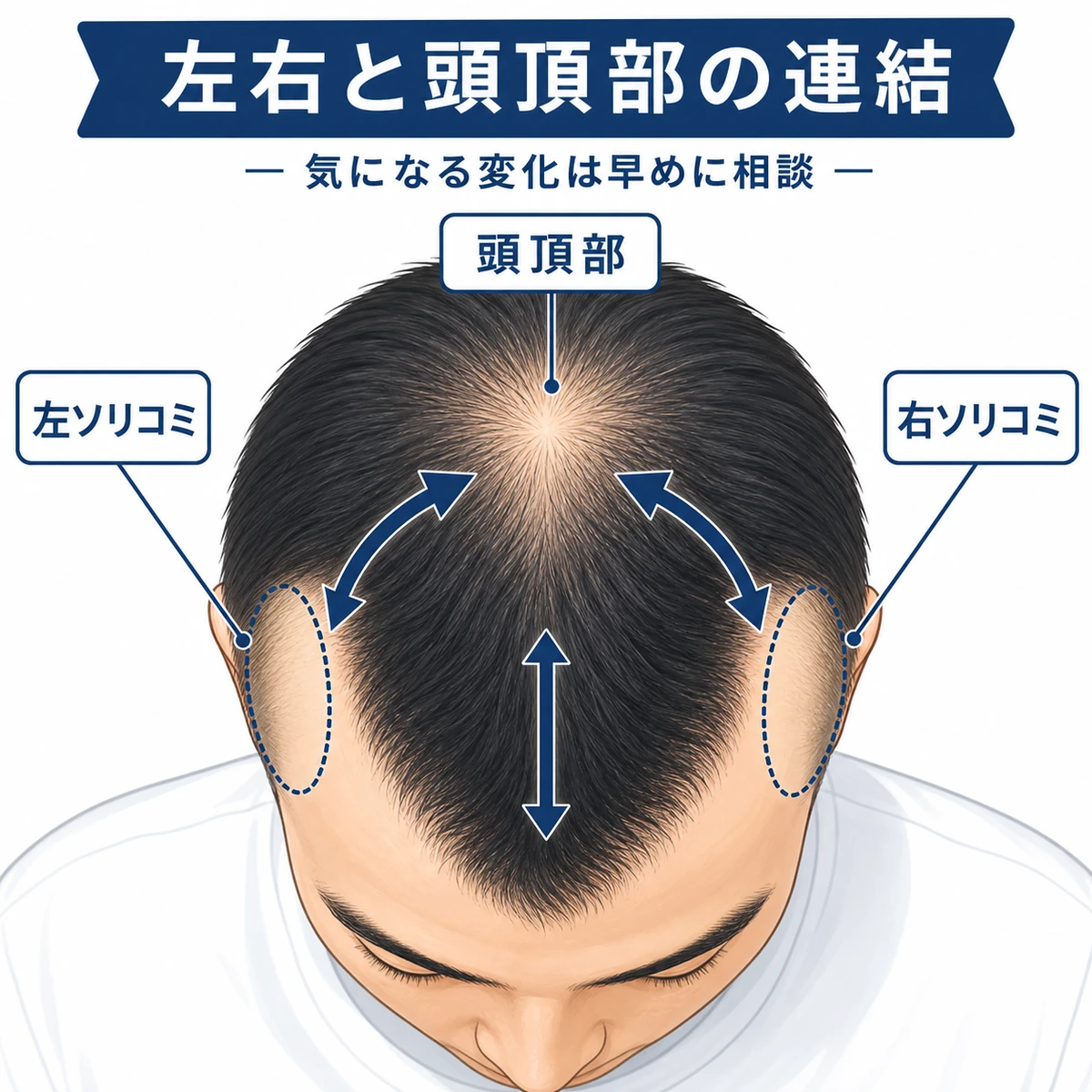 左右のソリコミと頭頂部が中央でつながっていく進行の流れを表した医療イラスト