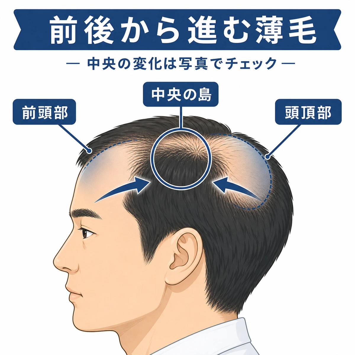 前頭部と頭頂部が同時に進み中央に髪が残るパターンを横から表した医療イラスト