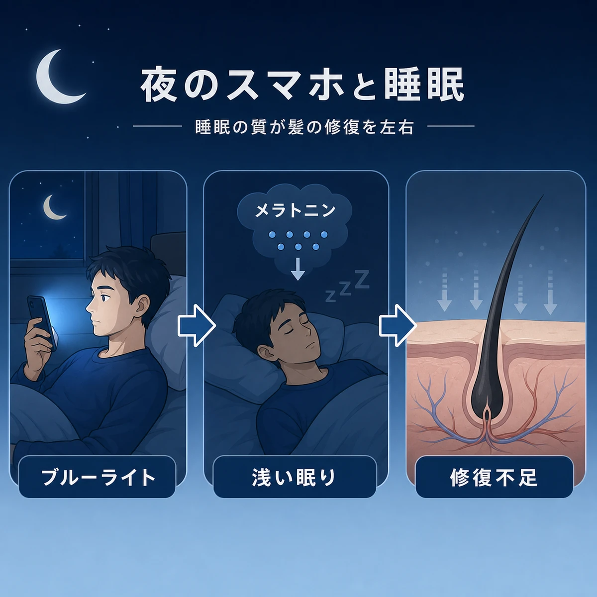 夜のスマホ使用が睡眠の質を下げ頭皮の修復を妨げる一連の流れを表現した医療イラスト