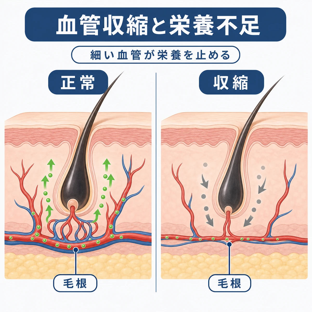 血管収縮で毛根への栄養が届かなくなる様子を比較した断面イラスト
