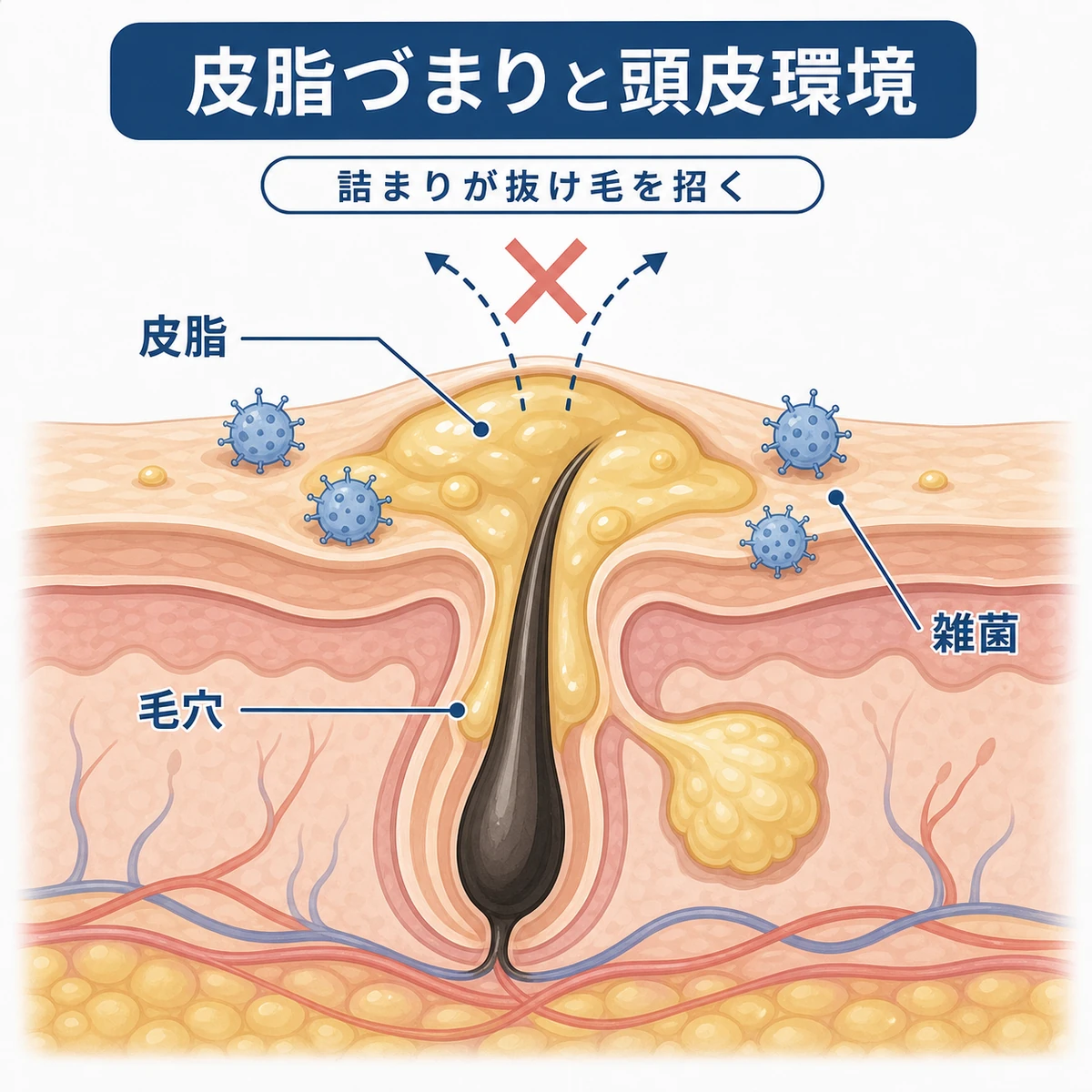 過剰な皮脂で毛穴が詰まる頭皮の状態を表した断面イラスト