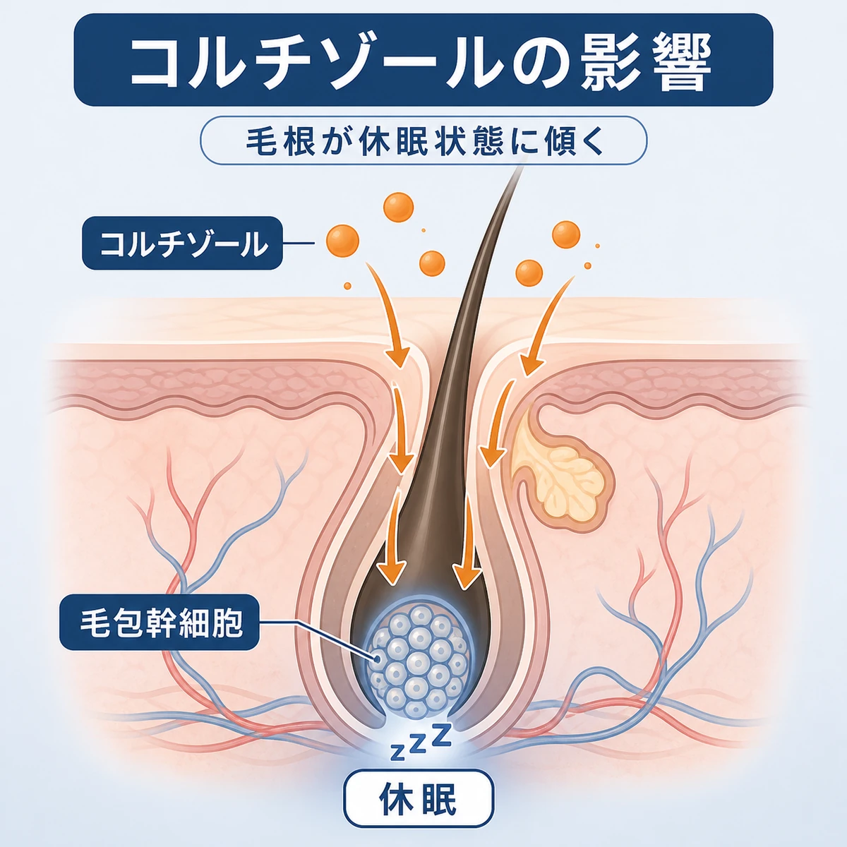 ストレスホルモンのコルチゾールが毛包幹細胞に作用して毛根を休眠させる仕組みを表した医療イラスト
