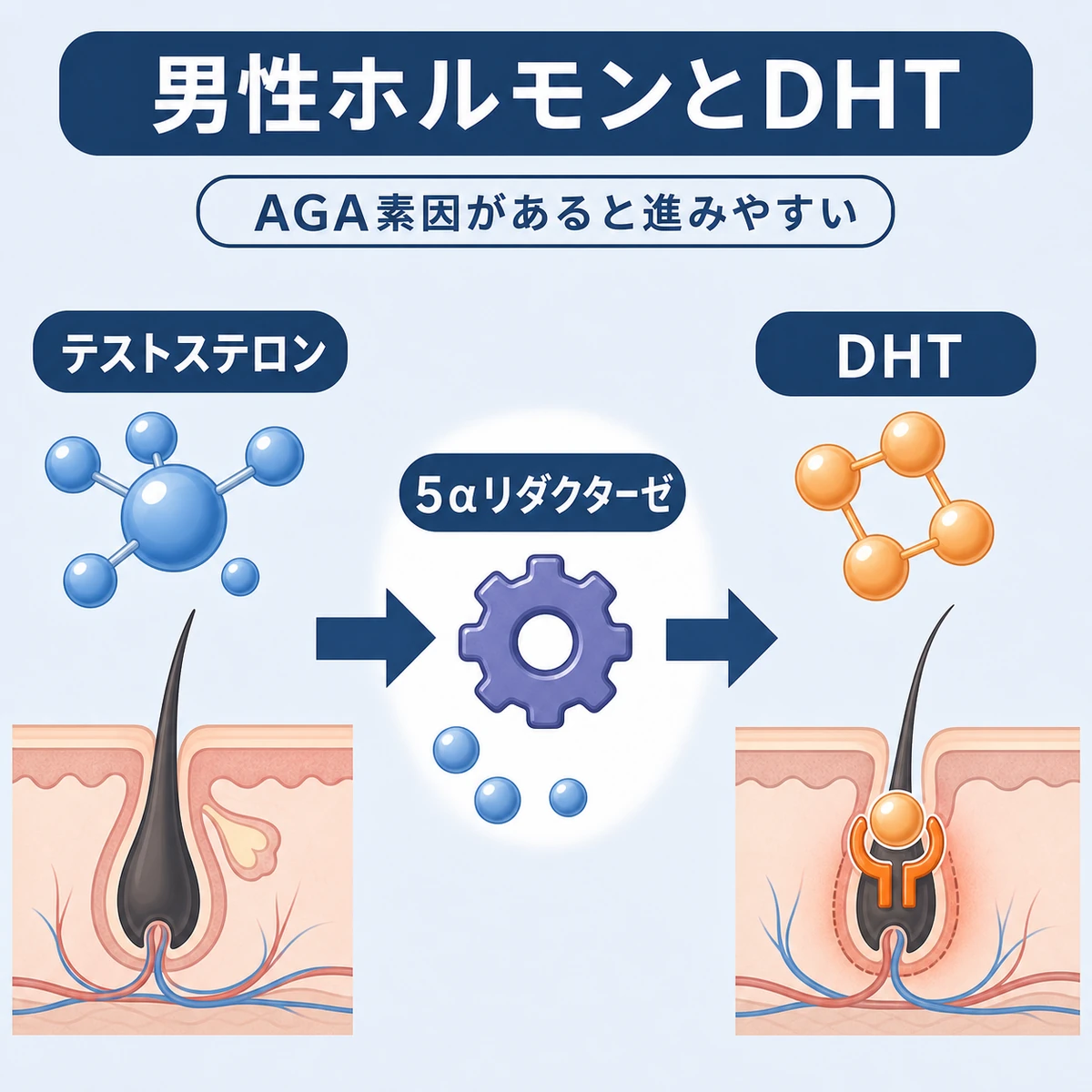 テストステロンが酵素でDHTに変わり毛根に作用して薄毛が進む流れを表した医療イラスト