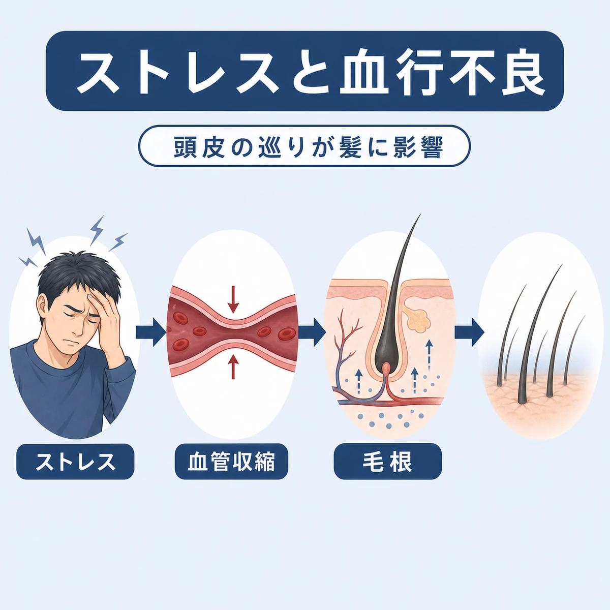 ストレスによる血行不良が毛根まで影響する流れを表した医療イラスト
