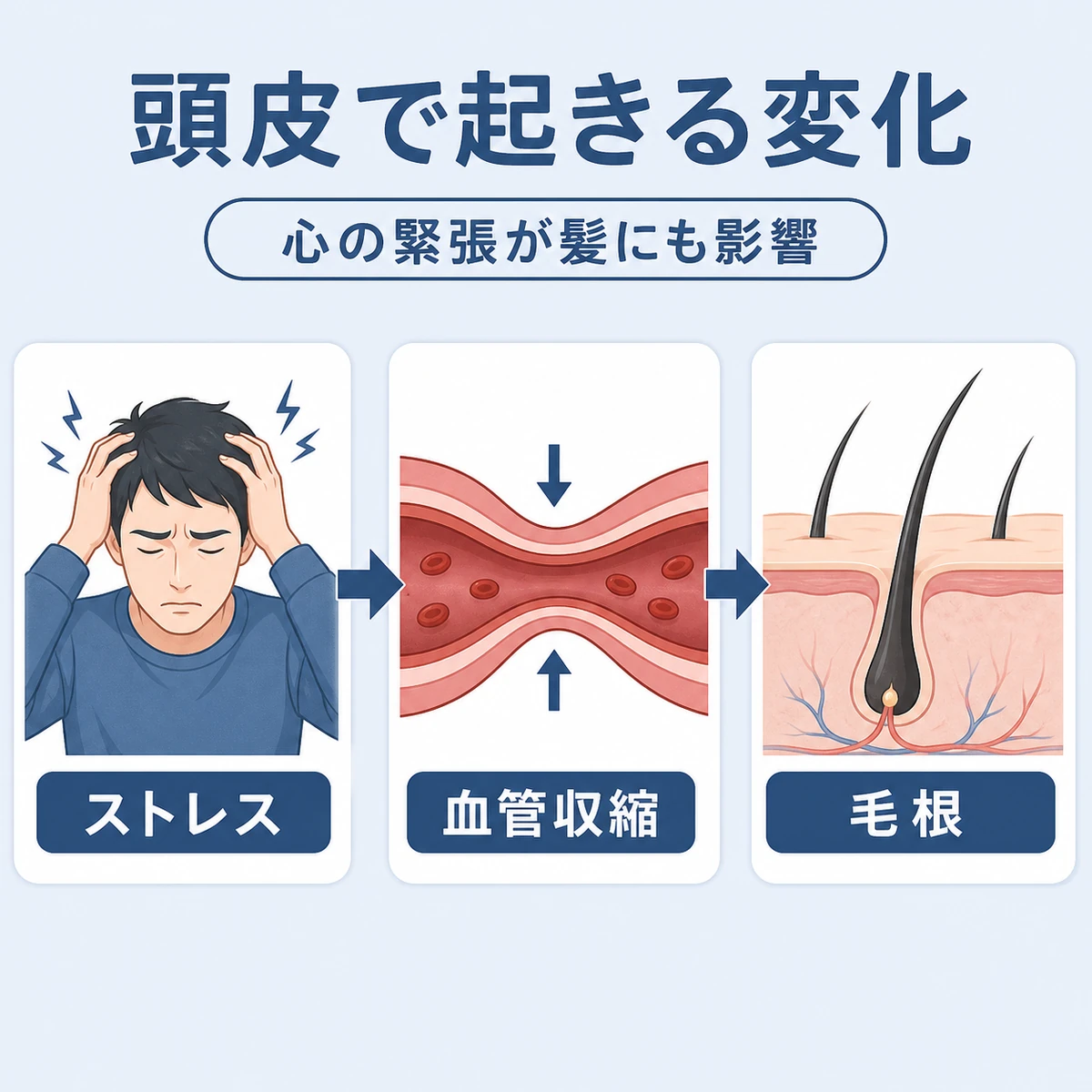 ストレスで頭皮の血管が収縮し毛根が弱る流れを表した医療イラスト