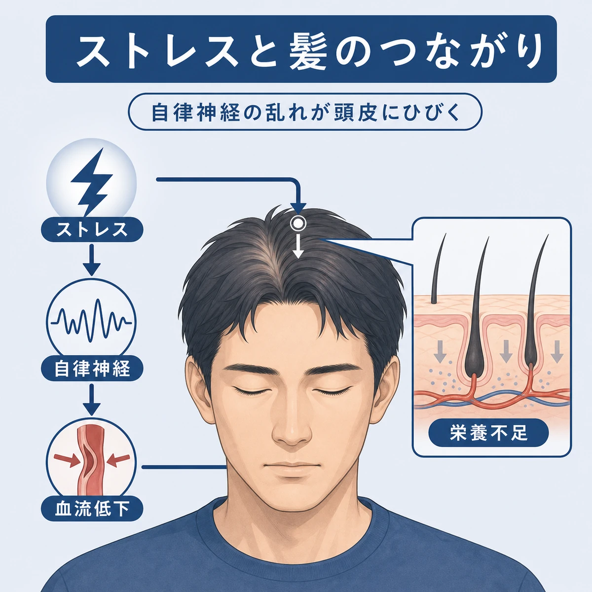 ストレスが自律神経を乱し頭皮の血流を下げる仕組みを表した医療イラスト