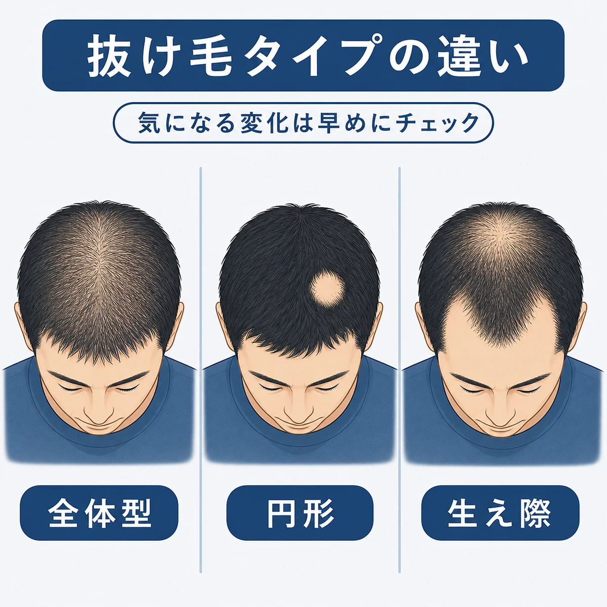 薄毛のタイプごとに抜け方が異なる特徴を並べて比較した医療イラスト