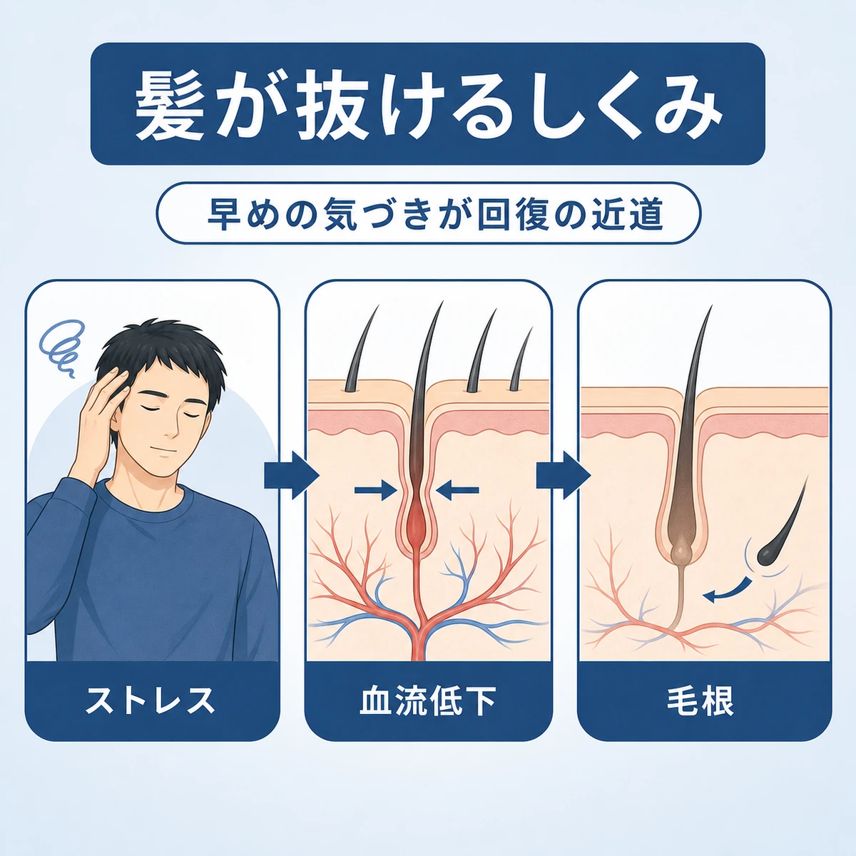 ストレスが頭皮の血流低下を通じて抜け毛につながる流れを表した医療イラスト