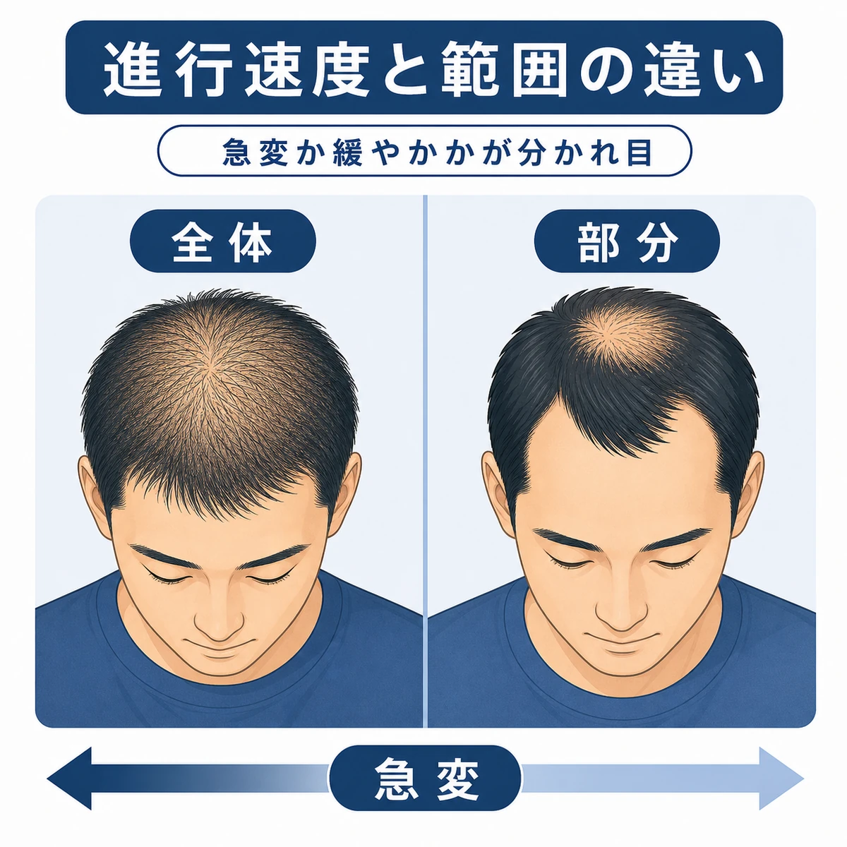 ストレス性脱毛症とAGAの進行範囲と速さの違いを左右で比べた医療イラスト
