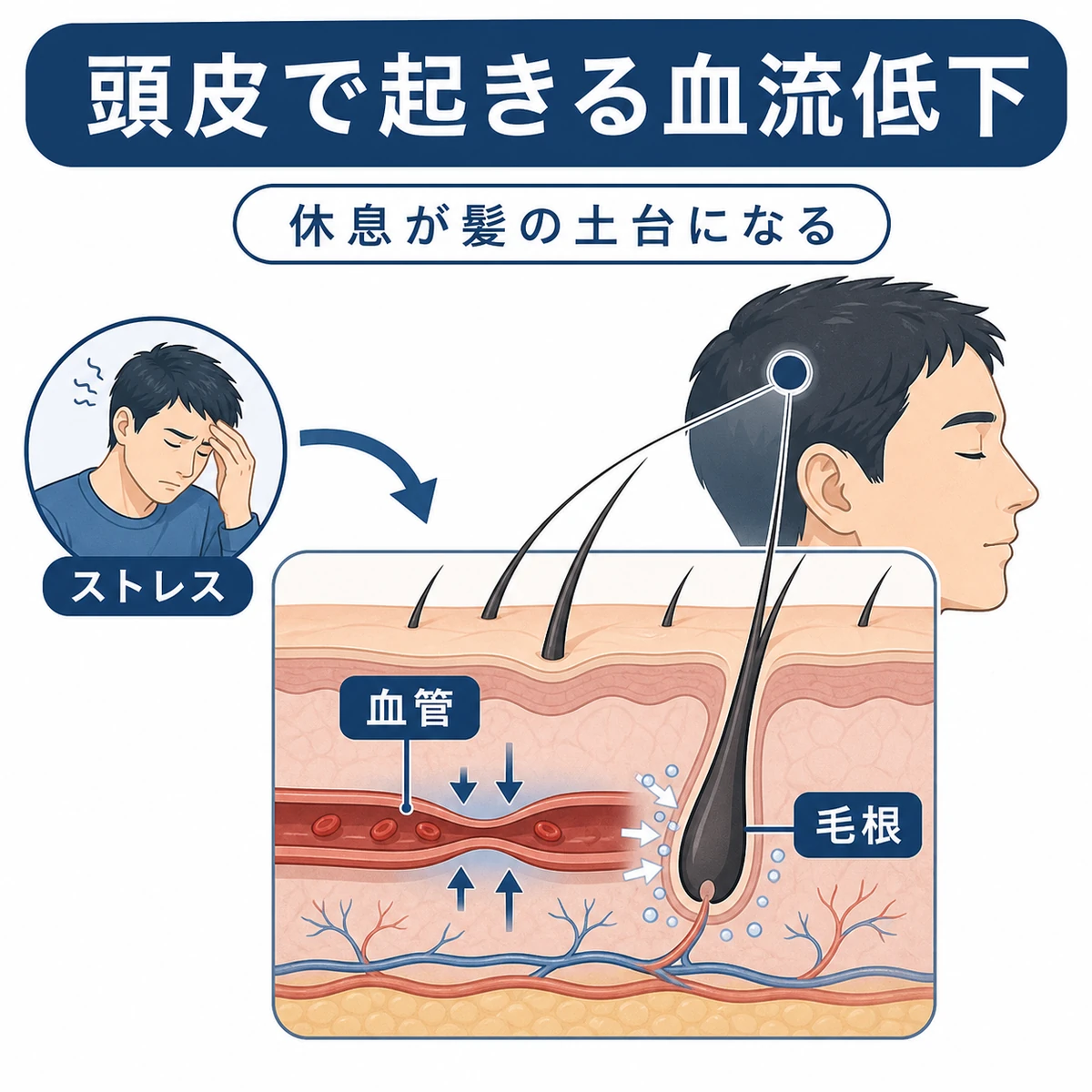 ストレスで頭皮の血流が低下し毛根に栄養が届きにくくなる仕組みを表した医療イラスト