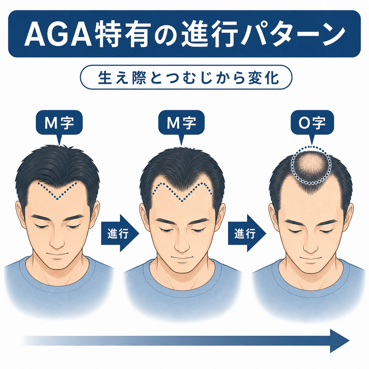 AGAの生え際と頭頂部が段階的に進行するパターンを表した医療イラスト