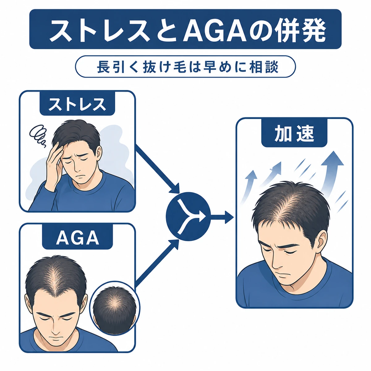 ストレスとAGAが重なって抜け毛が加速する併発リスクを表した医療イラスト