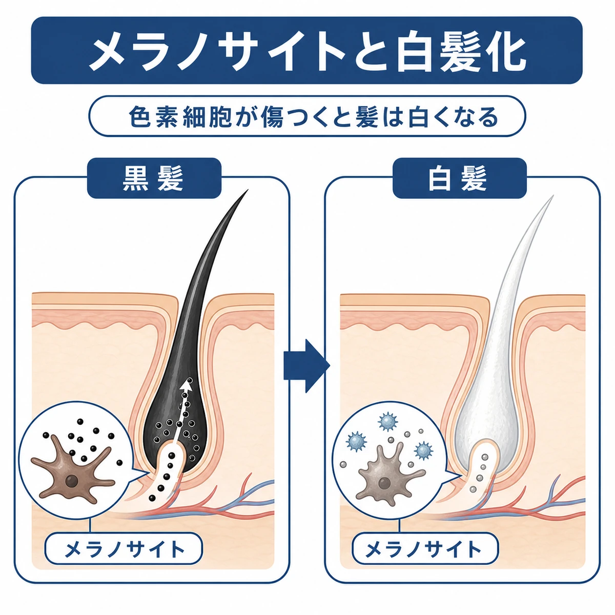 メラノサイトの損傷で黒髪が白髪に変わる流れを示した医療イラスト