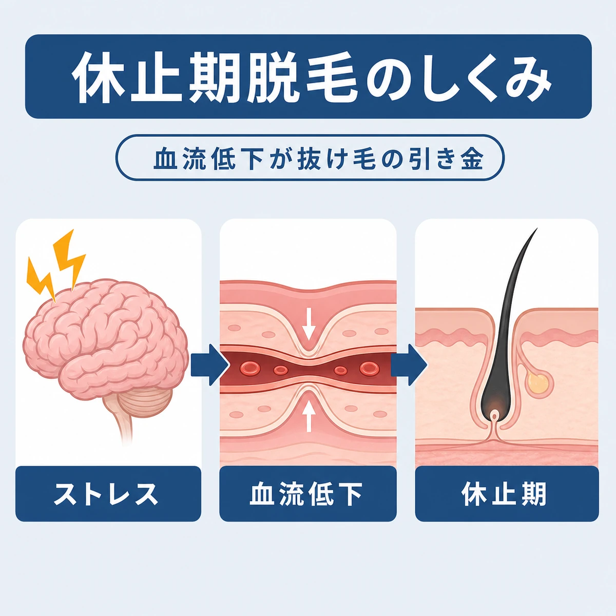ストレスによる血流低下が休止期脱毛を引き起こす流れを表した医療イラスト