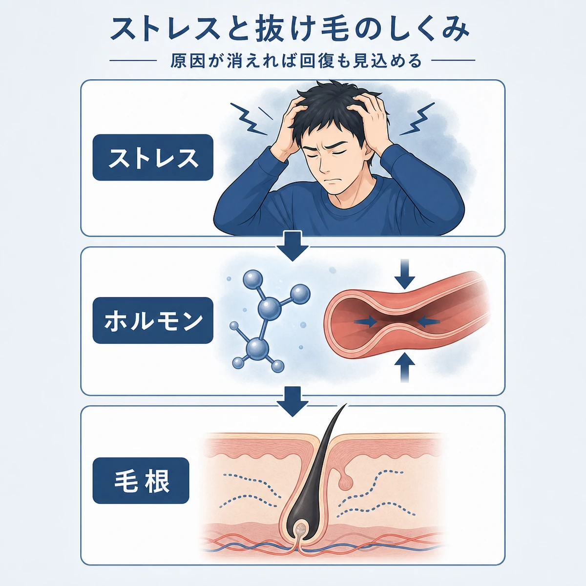 ストレスがホルモンを介して毛根の成長を止めるしくみを縦の相関図で表した医療イラスト