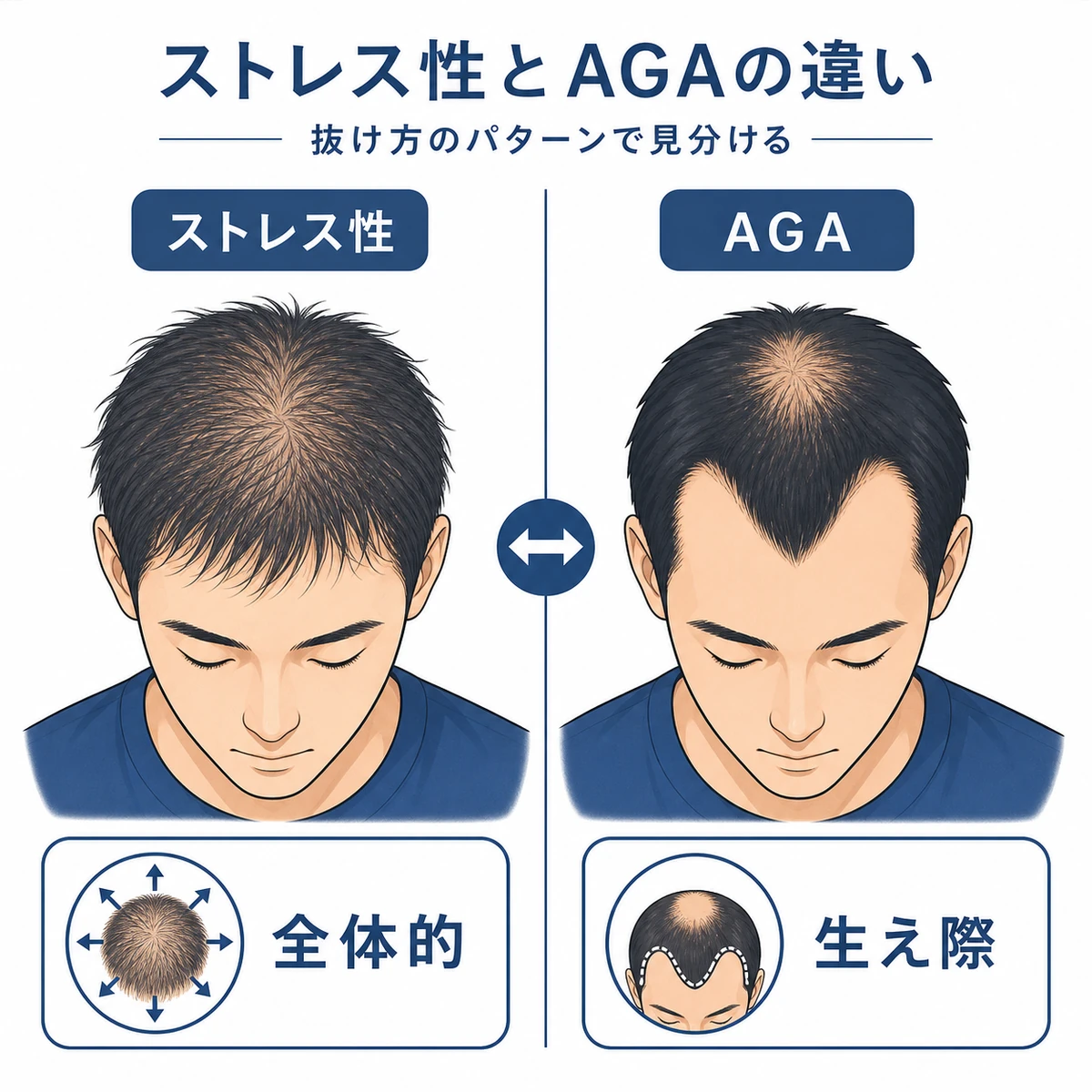 全体的に薄くなるストレス性と生え際から後退するAGAの抜け方の違いを左右で対比した医療イラスト