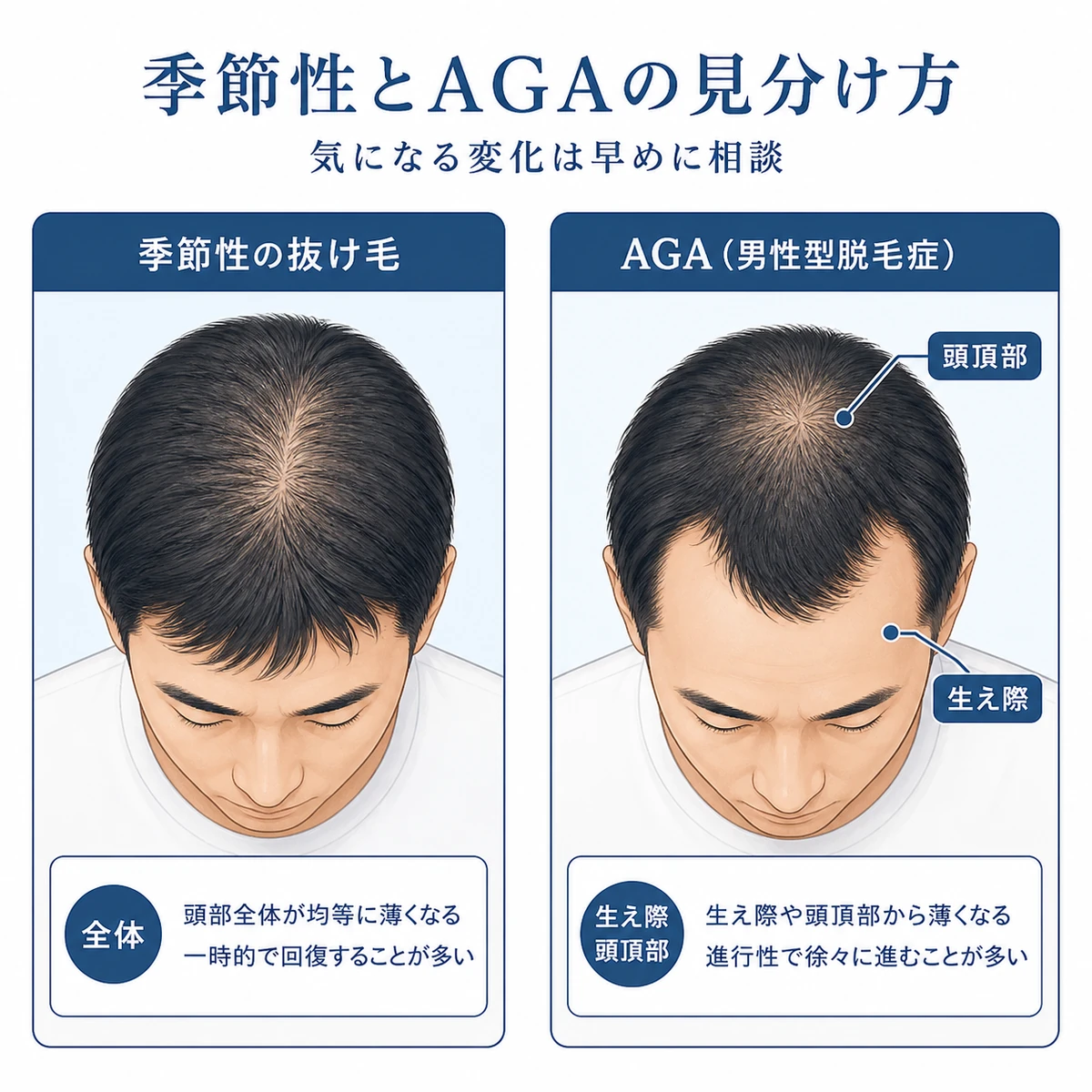 季節性の抜け毛とAGAの抜け方の違いを左右で比べた医療イラスト