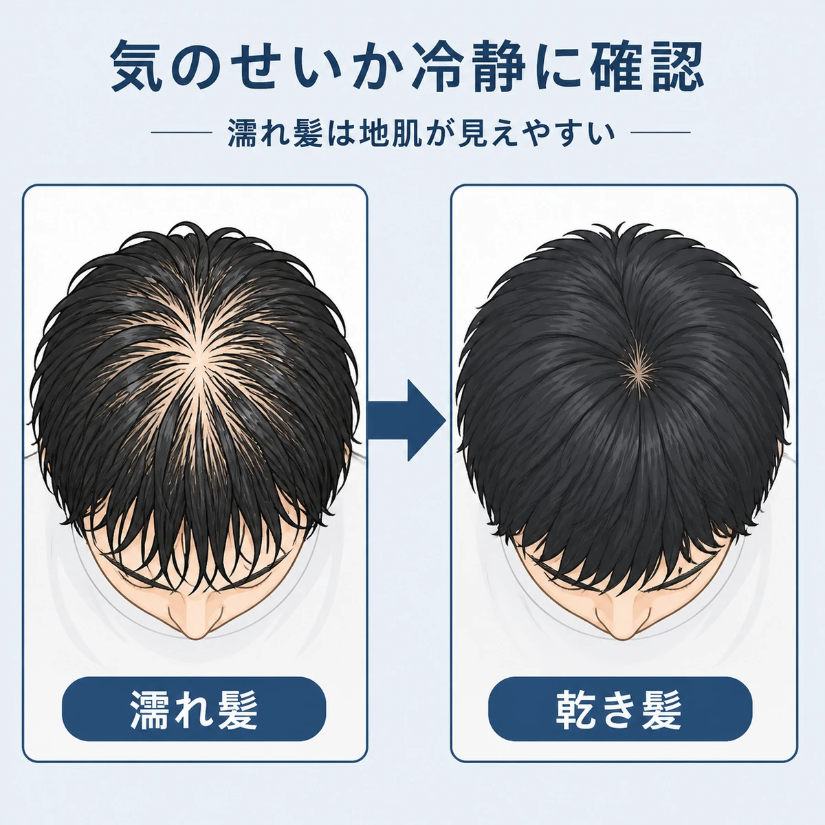 濡れた髪と乾いた髪でつむじの地肌の見え方が変わる様子を比べた医療イラスト