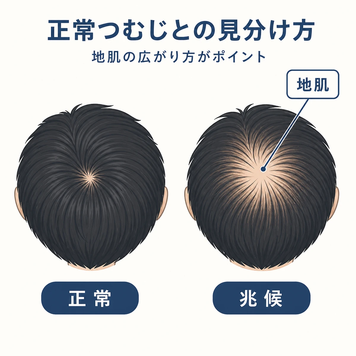 正常なつむじと地肌が放射状に広がった気になるつむじを見比べた医療イラスト