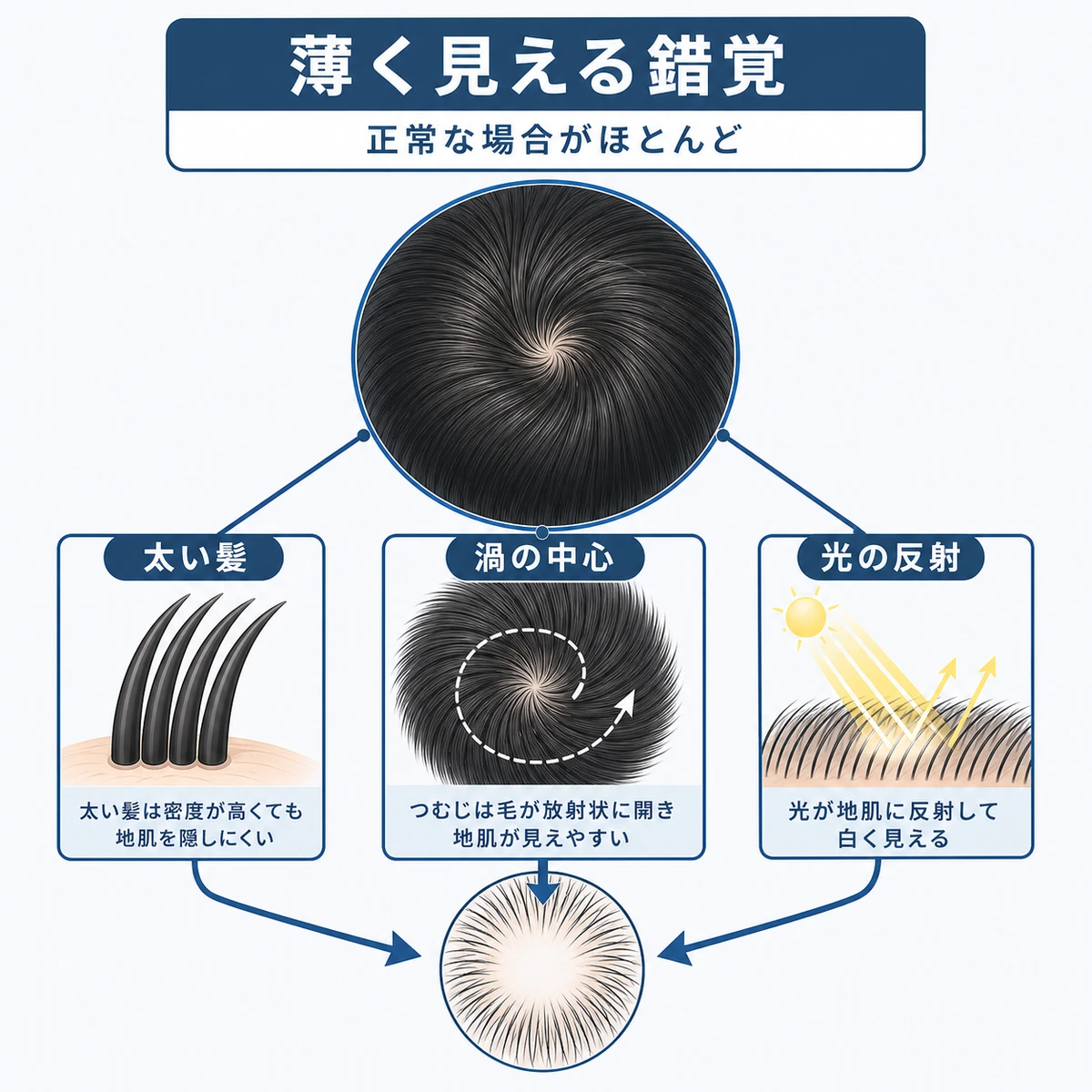 太い髪や渦の構造、光の反射で頭頂部の地肌が白く際立って見える仕組みを表した医療イラスト