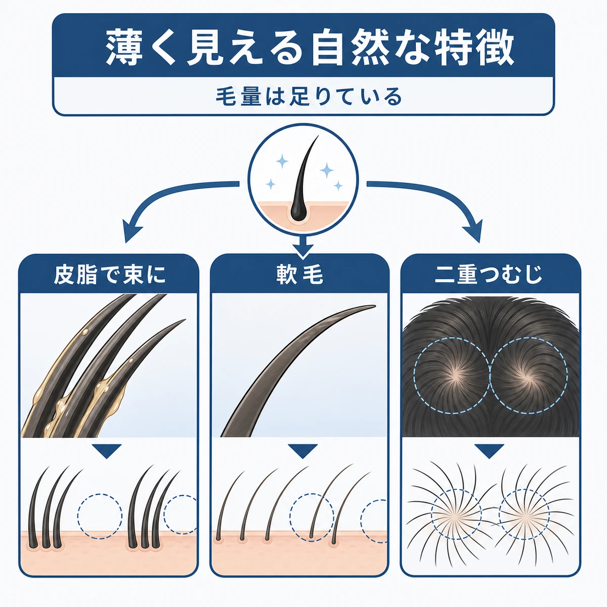 皮脂による束感・軟毛・ダブルつむじという薄く見える髪の特徴を並べて比べた医療イラスト