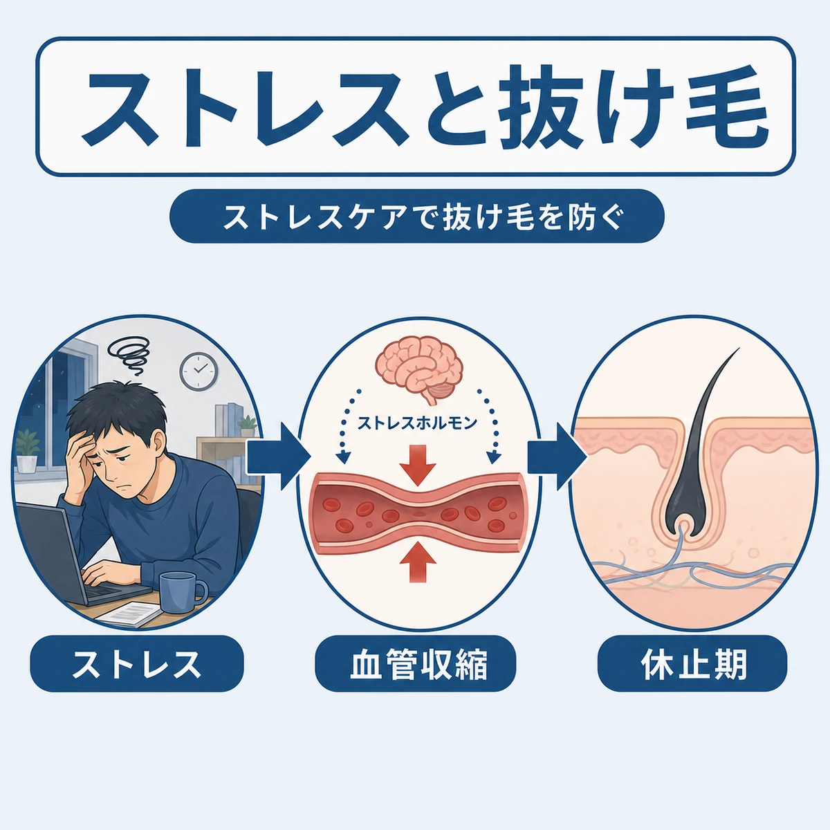ストレスがコルチゾールを通じて抜け毛を招く経路を示した医療イラスト