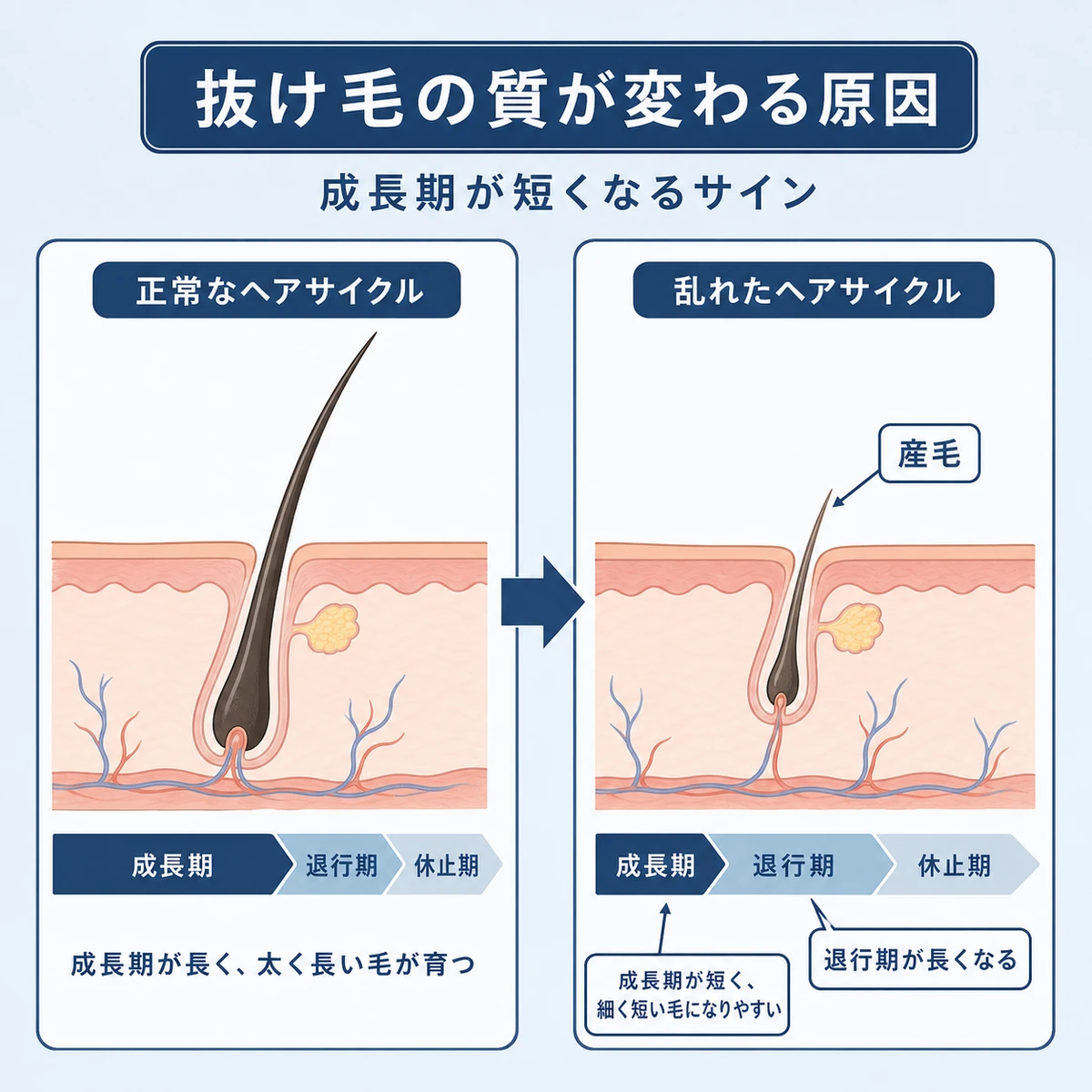 正常なヘアサイクルと成長期が短縮した状態を見比べた医療イラスト