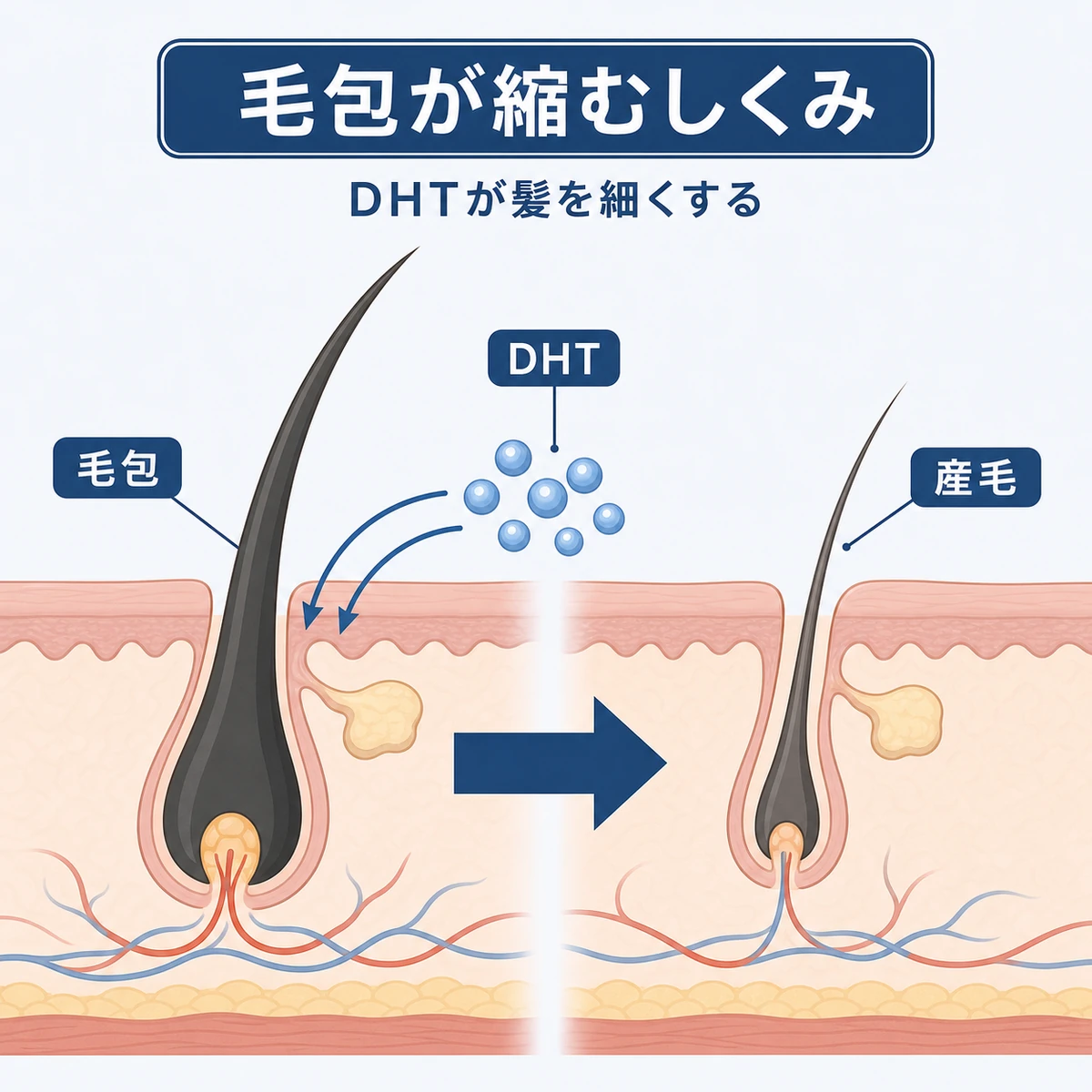 DHTの影響で毛包が縮小していくミニチュア化のしくみを表した医療イラスト