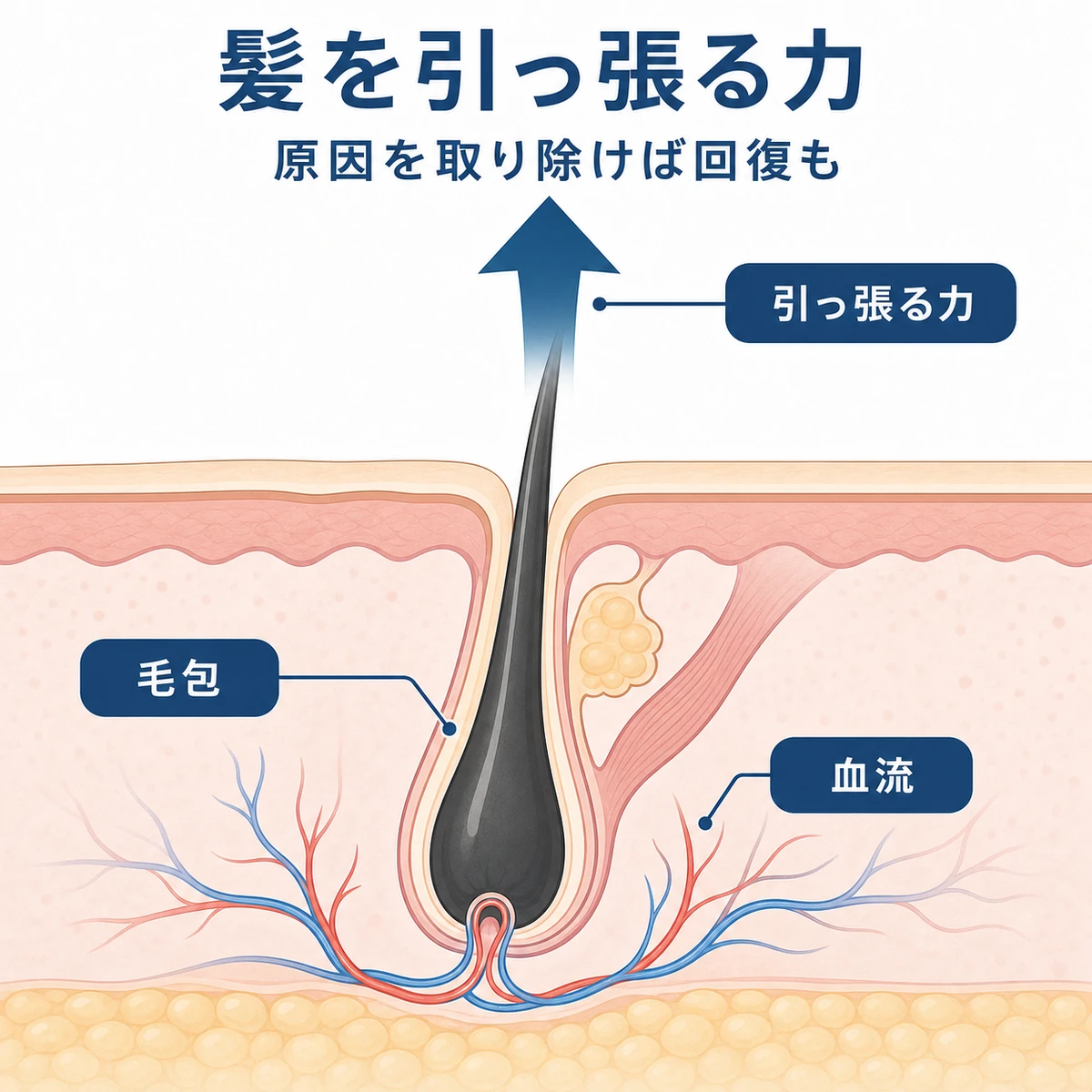 髪を引っ張る力が毛包に伝わり毛根の血流が滞る仕組みを描いた頭皮断面の医療イラスト