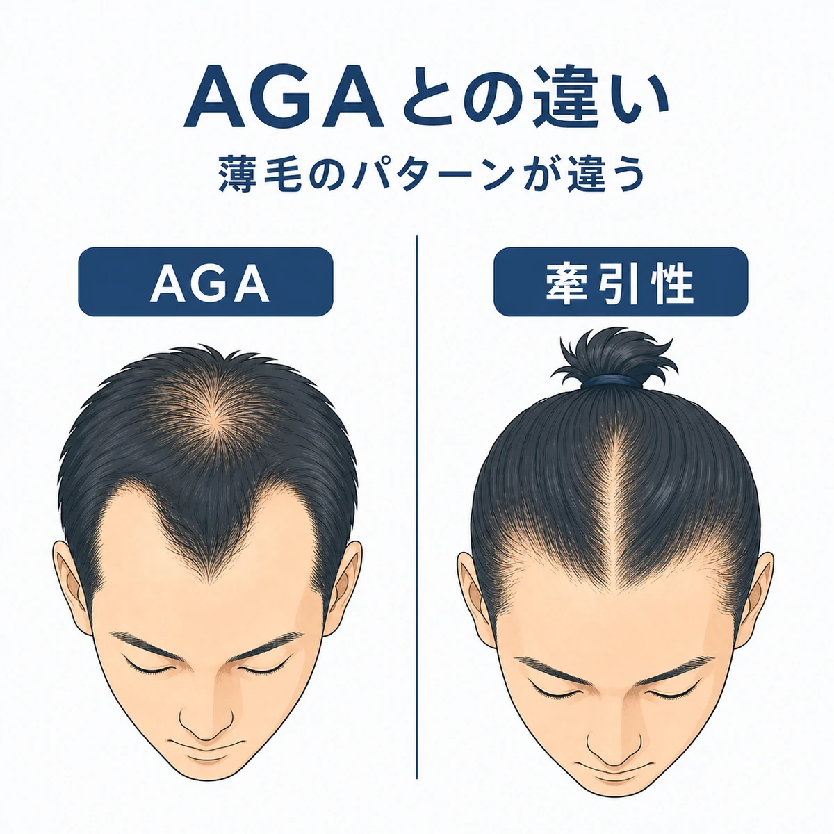 M字に進むAGAと結び目周辺に集中する牽引性脱毛症の薄毛の違いを左右で比べた成人男性の医療イラスト