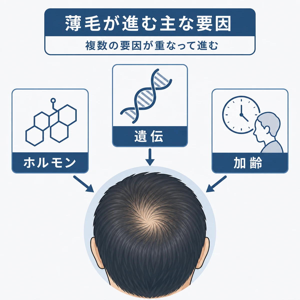 つむじはげにつながる複数の要因が頭頂部に重なるしくみを表した医療イラスト
