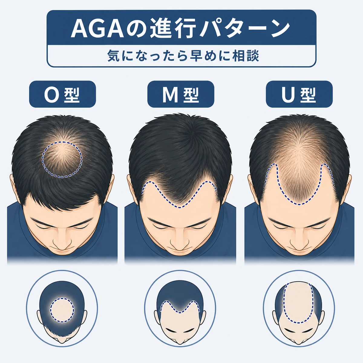 AGAによる薄毛の進行パターンを頭頂部の俯瞰図で並べた医療イラスト