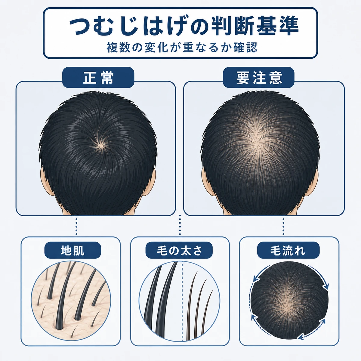 正常なつむじと薄毛が疑われるつむじを地肌・毛の太さ・毛流れの観点で比べた医療イラスト