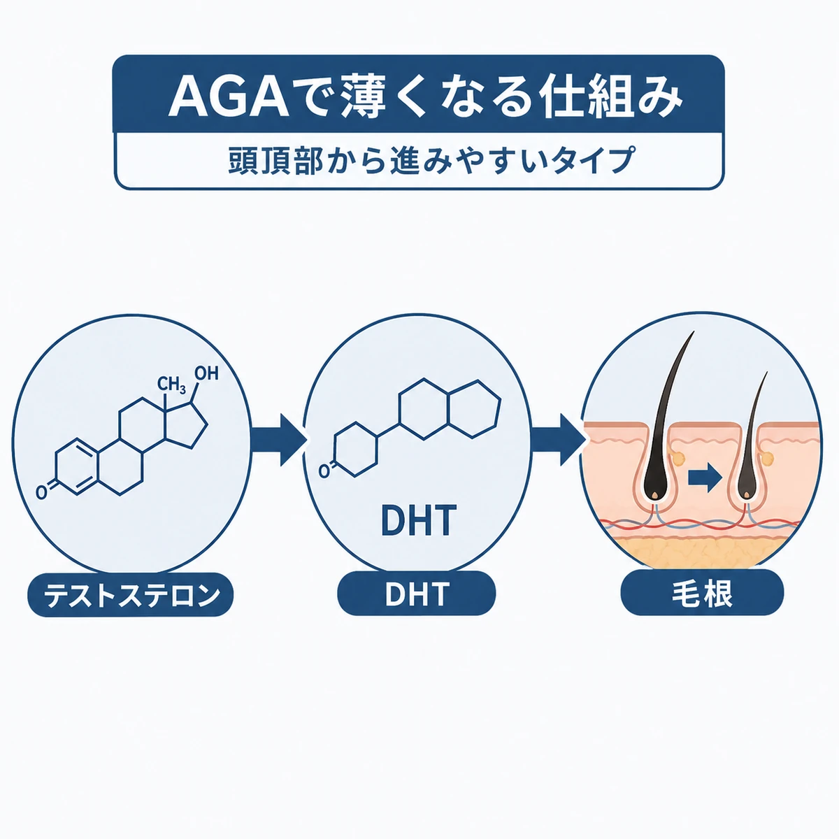 男性ホルモンがDHTに変わり毛根を弱らせるAGAの進行の流れを表した医療イラスト