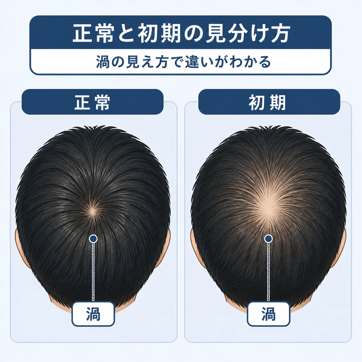 正常なつむじと初期のつむじを真上から左右で比べた頭頂部の医療イラスト