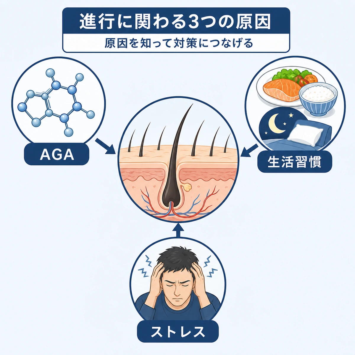 AGAと生活習慣とストレスが頭皮に影響する関係を矢印でつないだ相関図の医療イラスト