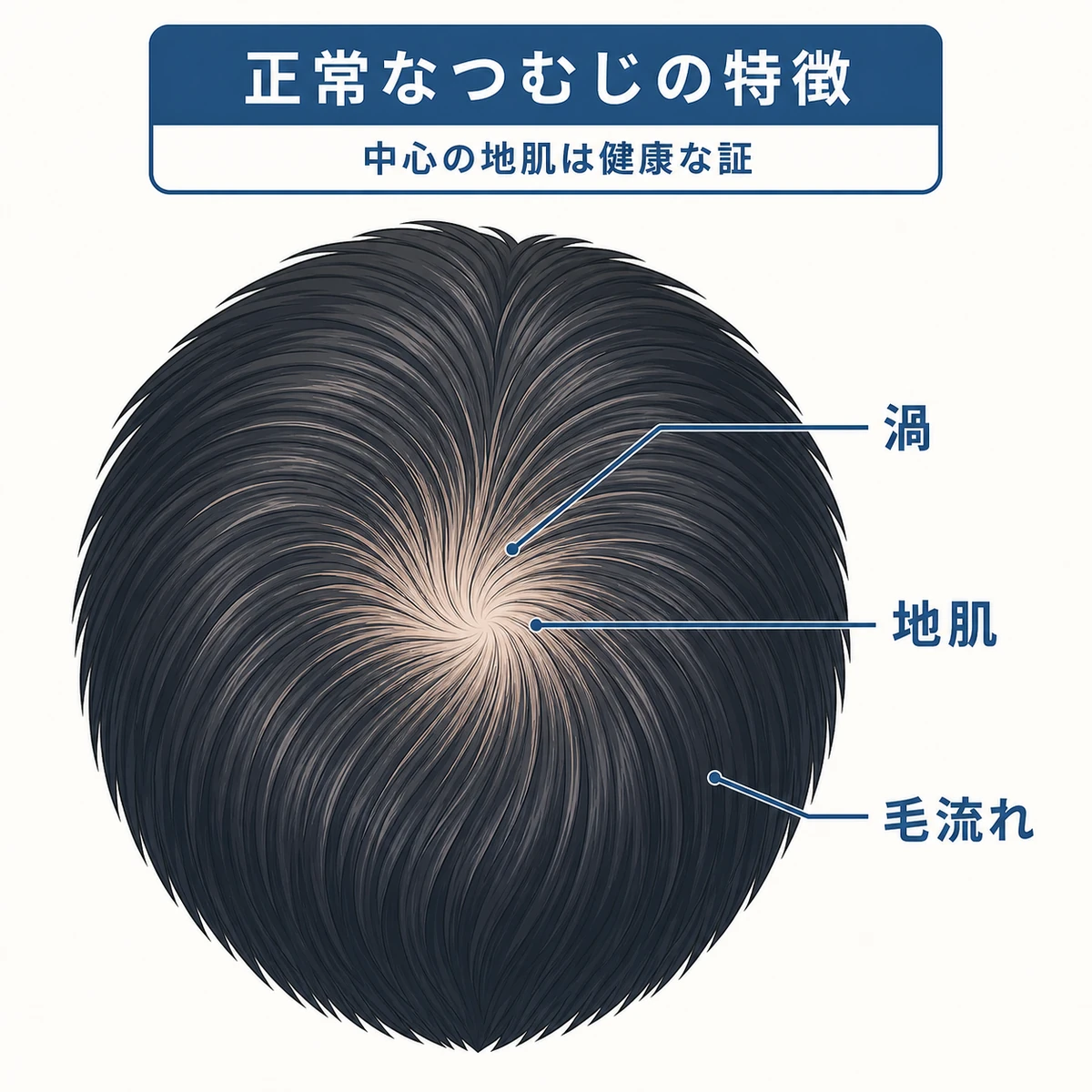 頭頂部の渦から髪が放射状に広がり中心の地肌が見える正常なつむじの構造を表した医療イラスト