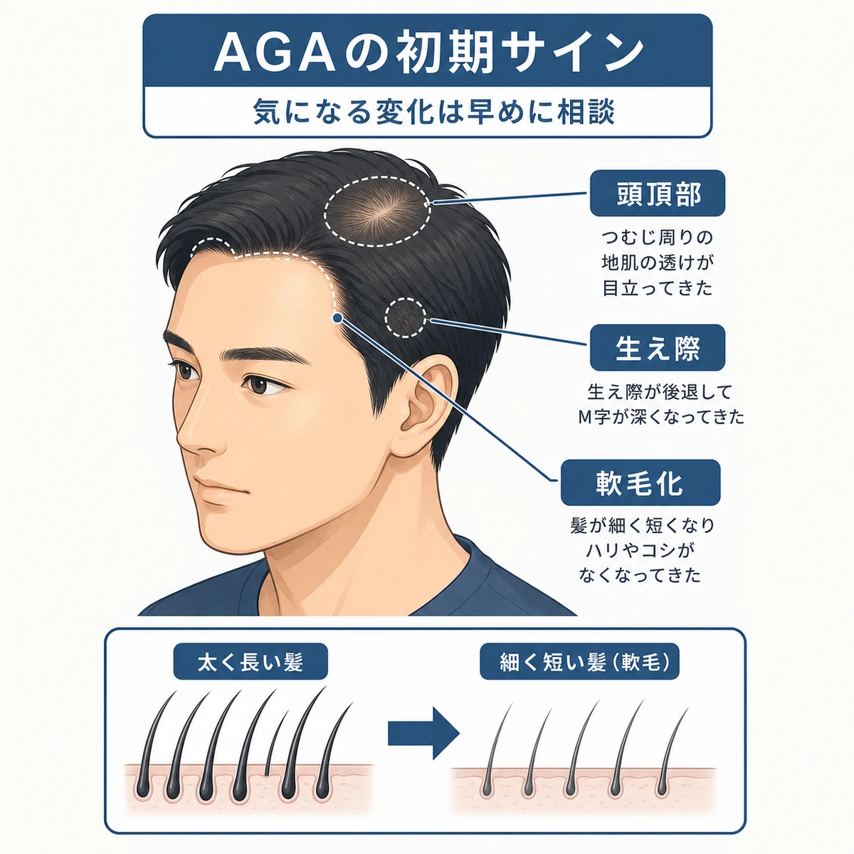 頭頂部と生え際から進む変化と髪の軟毛化を成人男性で表したAGAの初期サインの医療イラスト