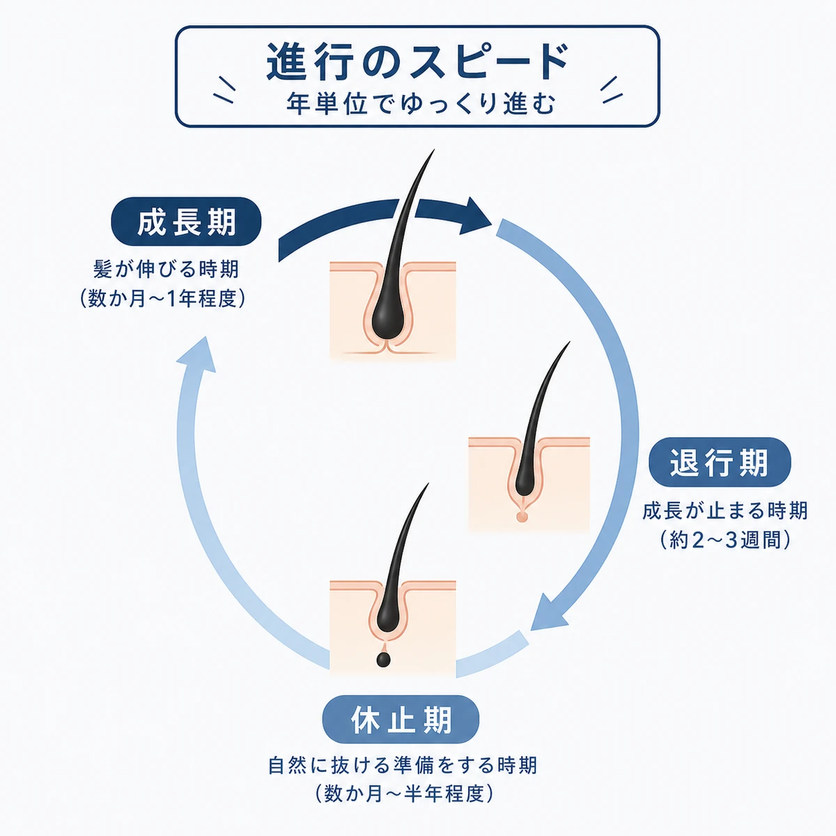 ヘアサイクルの成長期が短くなり髪が育ちにくくなる流れを表した医療イラスト