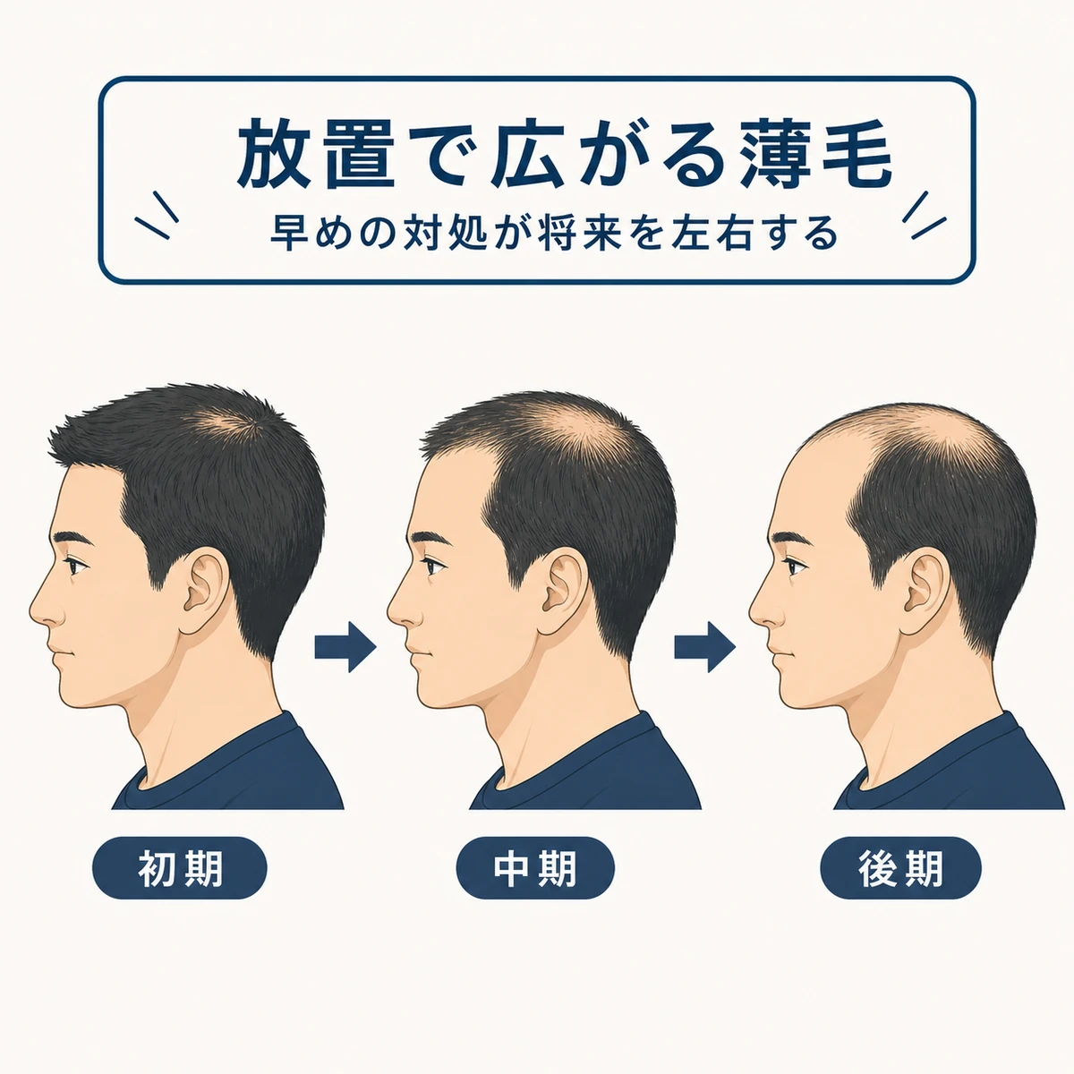 放置によって頭頂部から前頭部へ薄毛が広がる進行段階を横顔で表した医療イラスト