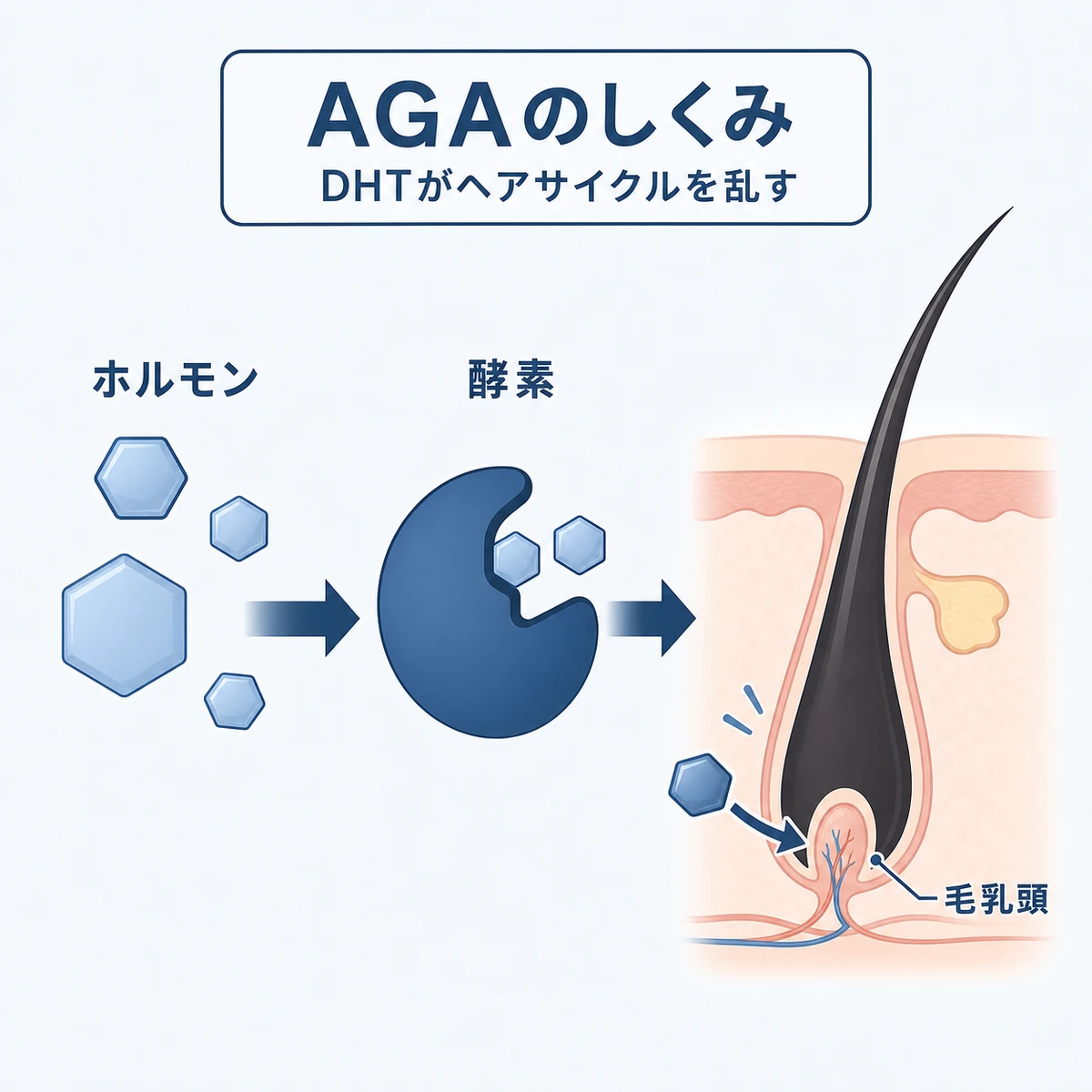 テストステロンが酵素と結びつきDHTとなって毛根に作用するAGAの仕組みを表した医療イラスト