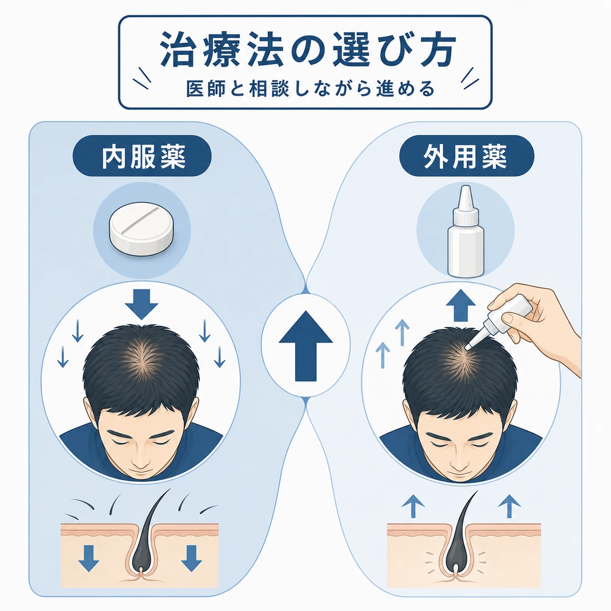 内服薬と外用薬を組み合わせて進行を抑え発毛を促すAGA治療の選び方を表した医療イラスト