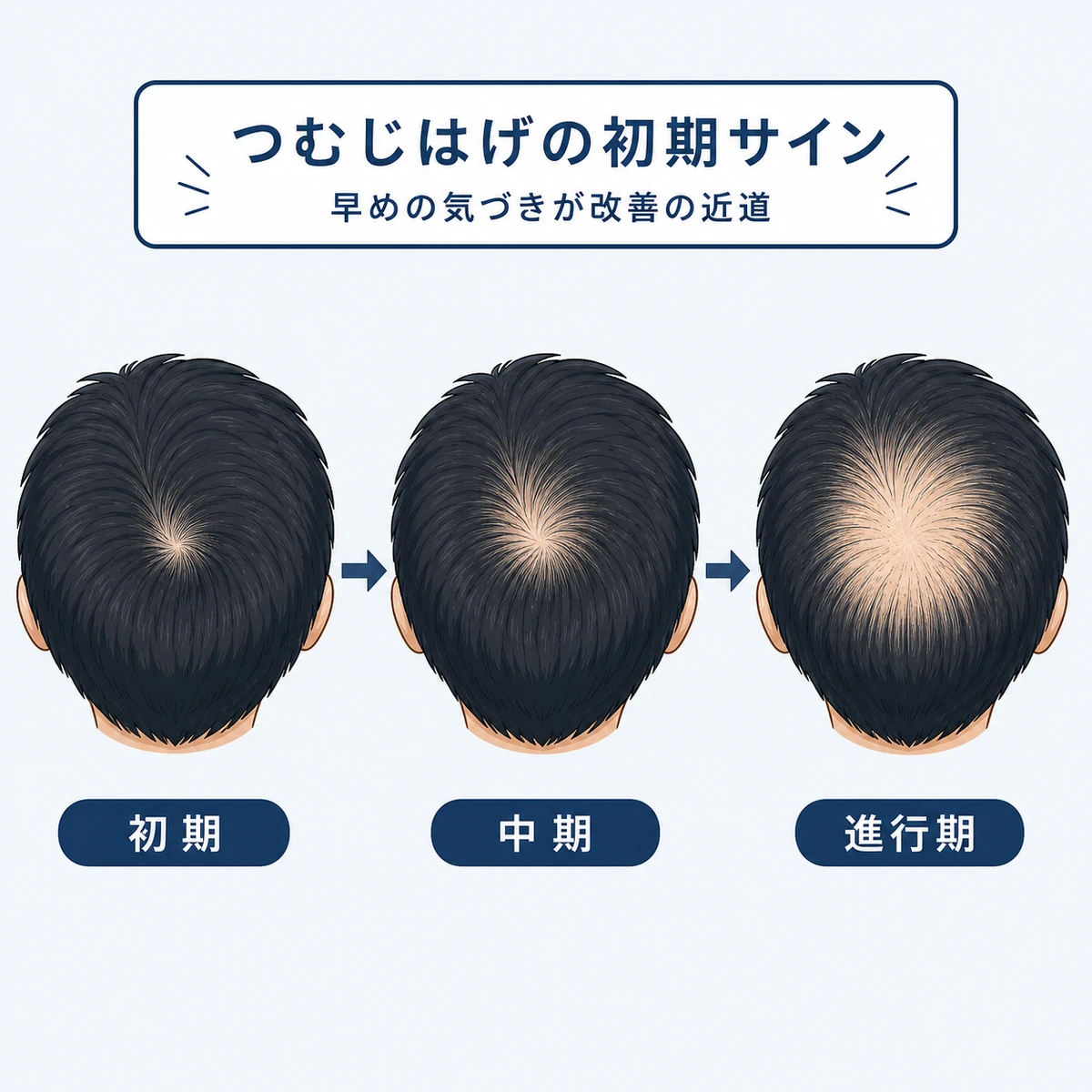 成人男性の頭頂部の薄毛が初期から進行期へ変化する様子を段階的に表した医療イラスト