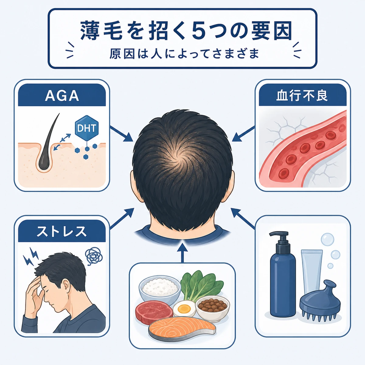 成人男性のつむじの薄毛に複数の原因が関わる関係性を表した医療イラスト