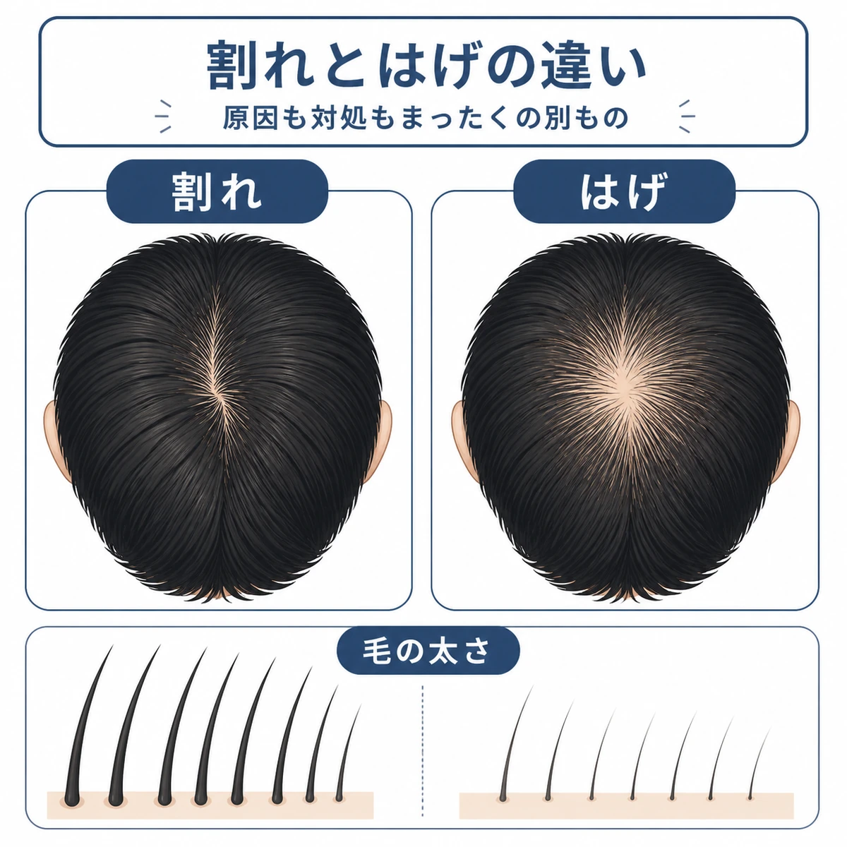 つむじ割れとつむじはげの頭頂部を左右で並べて違いを表した医療イラスト
