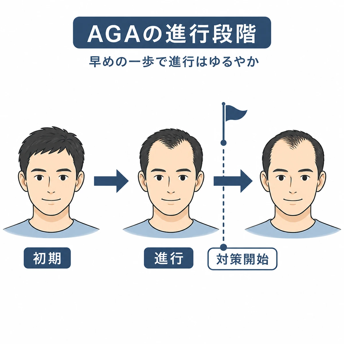AGAの進行段階と早めに対策を始める分岐点を表した医療イラスト