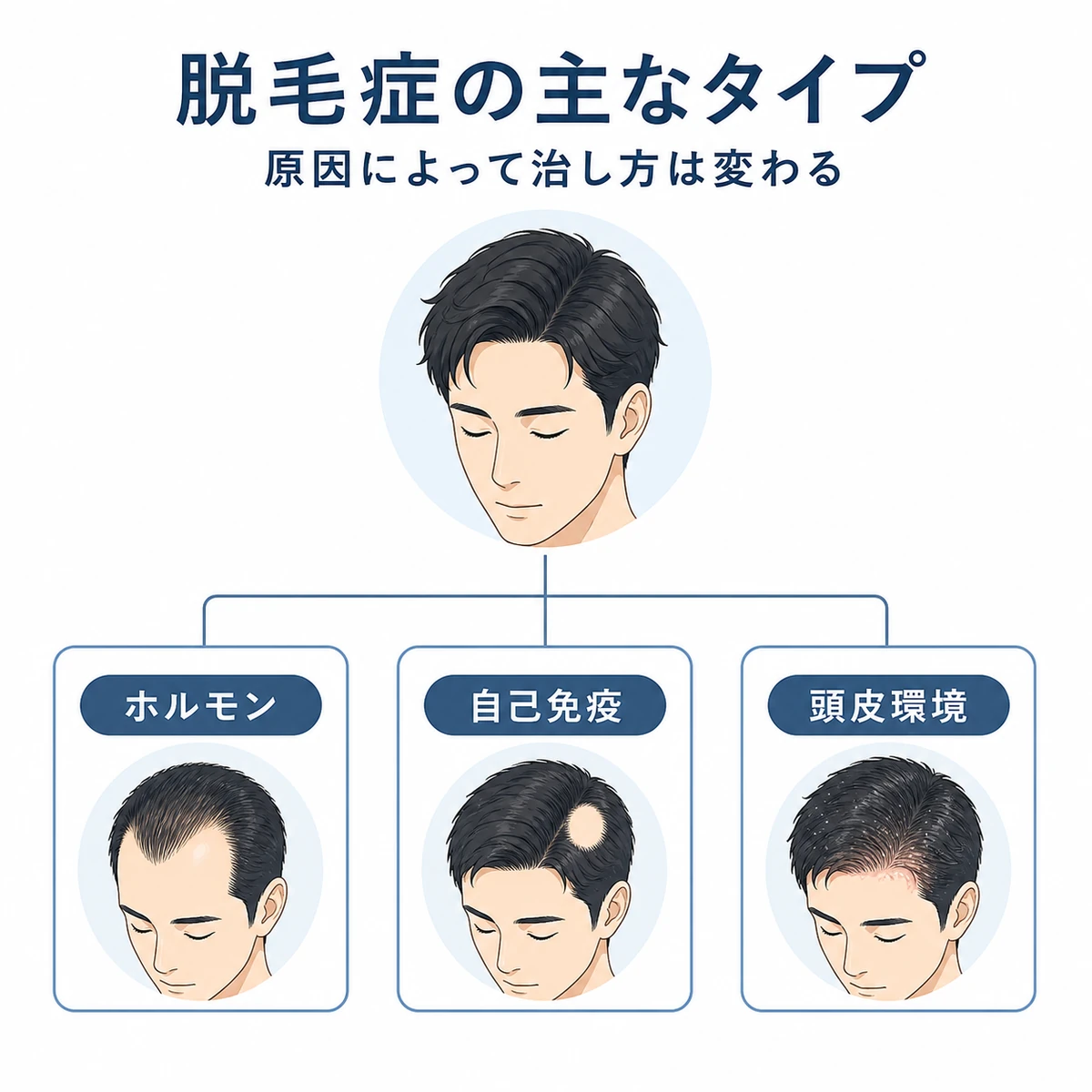 脱毛症を原因別に分類した全体像を表した医療イラスト