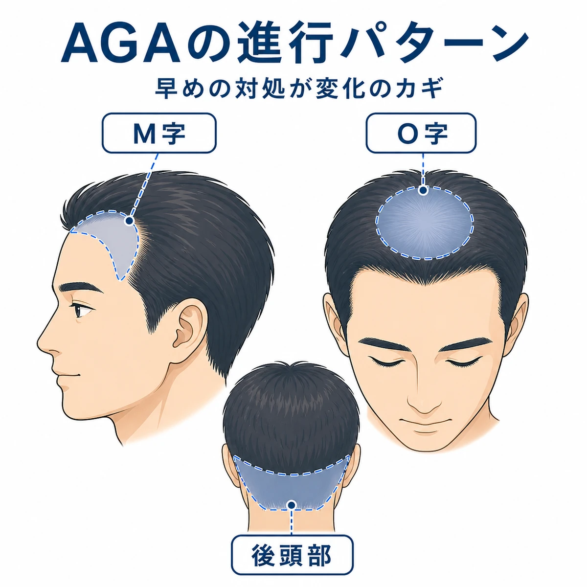 AGAで薄くなりやすい生え際と頭頂部の進行パターンを表した医療イラスト