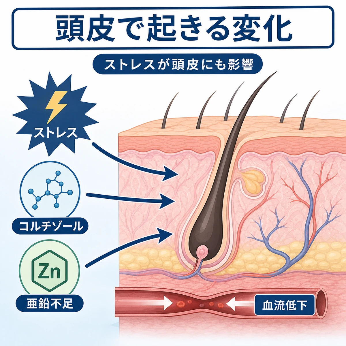 ストレスで頭皮の血流や栄養状態が変化するしくみを表した医療イラスト