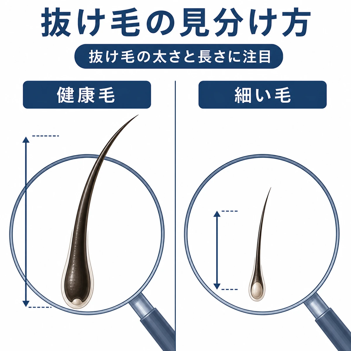 ストレス性の抜け毛と健康な髪の太さや長さの違いを比較した医療イラスト